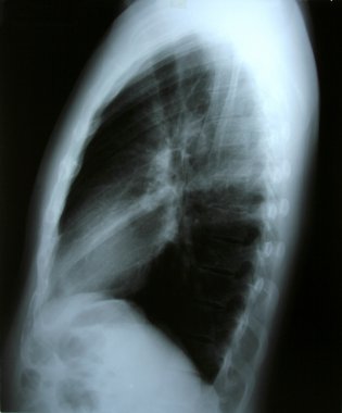 Akciğer xray