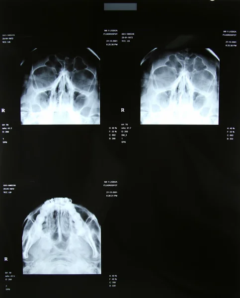 stock image Sinus x-rays