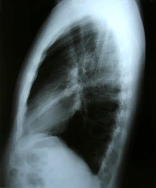 Radiografia polmonare — Foto Stock